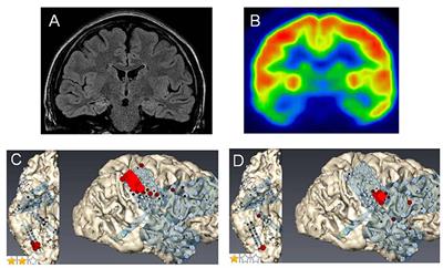 Tailor-Made Surgery Based on Functional Networks for Intractable Epilepsy